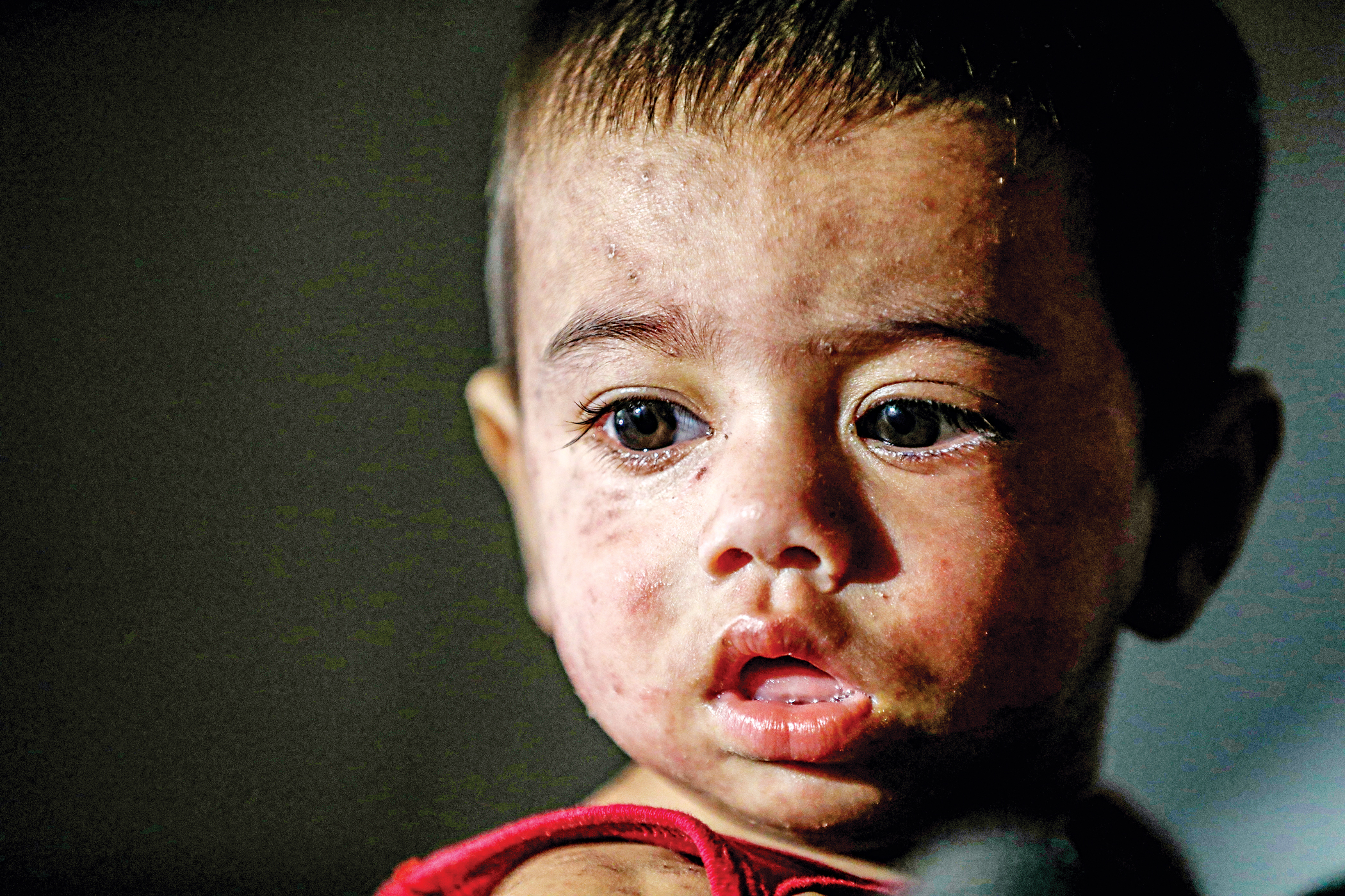 After measles, debt crushes the poor