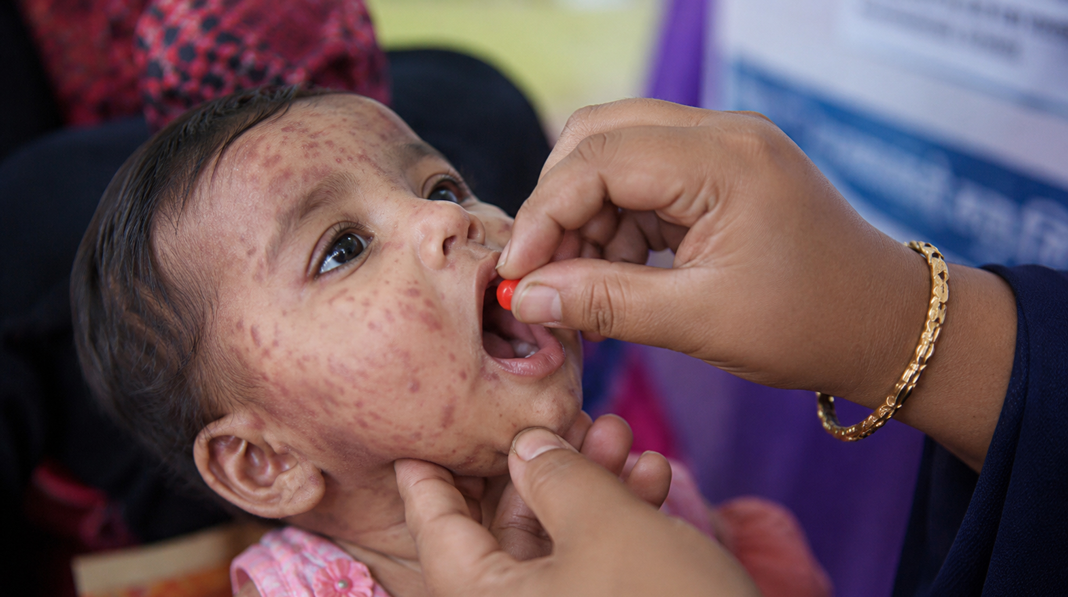 As measles spreads, vitamin A emerges as a lifesaving shield