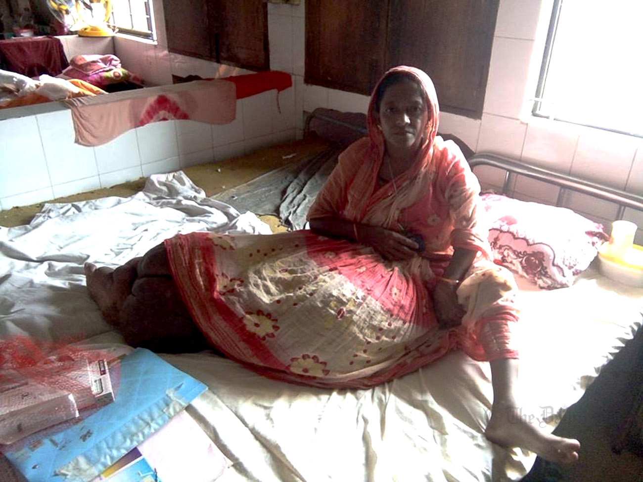 Woman with 60kg leg at Dhaka medical