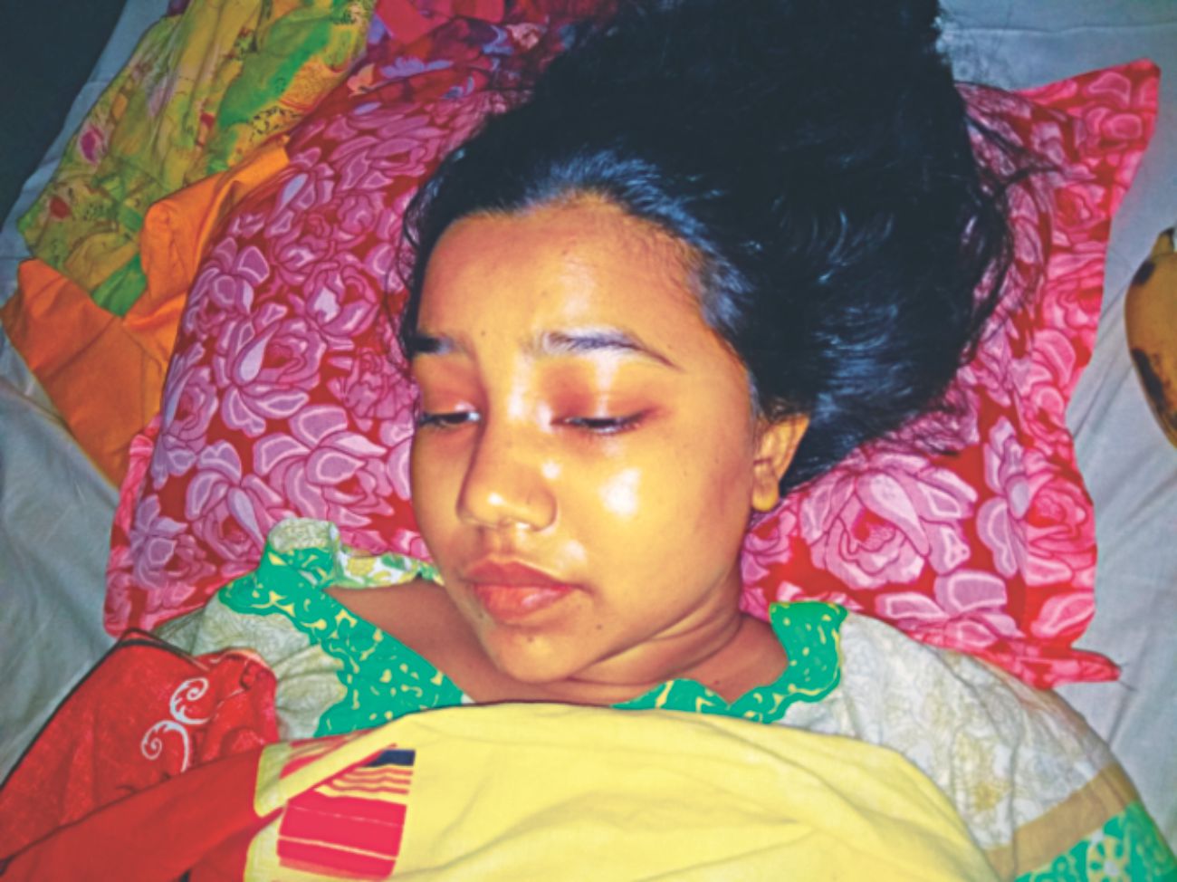 Run over by bus, teen loses leg