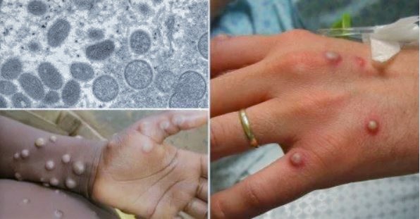 UN says some media coverage of monkeypox stigmatises Africans, LGBTI people