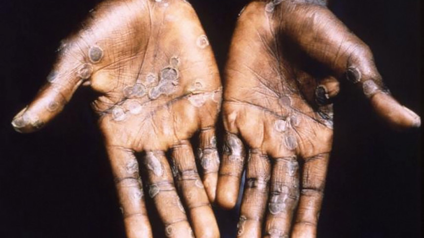 Monkeypox: WHO for new vaccine-sharing mechanism to curb inequality 