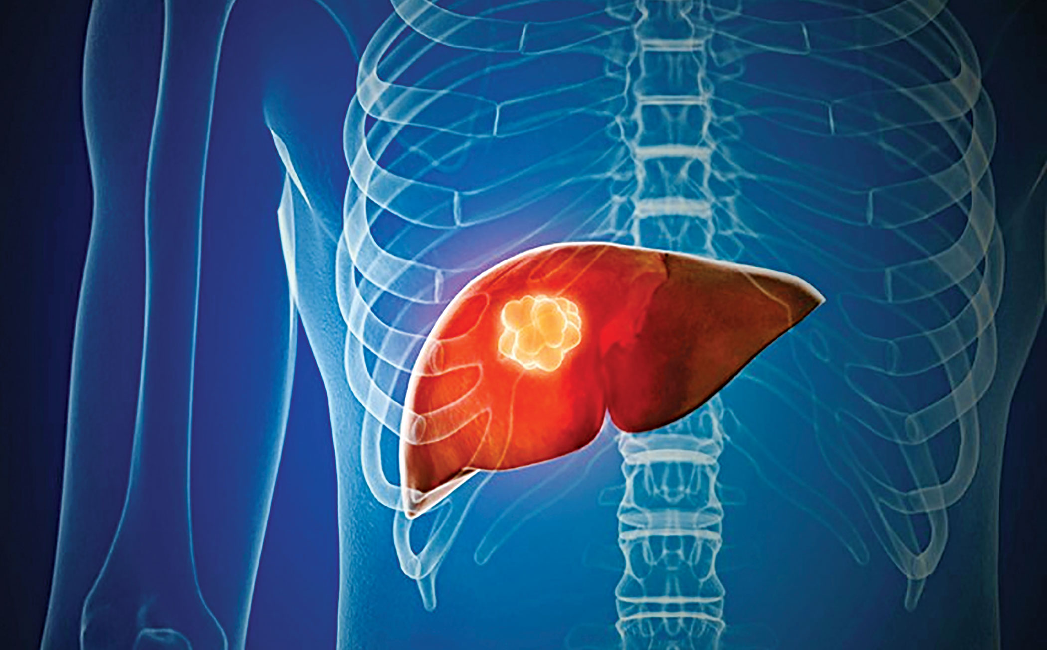 Might metformin protect against hepatocellular carcinoma?