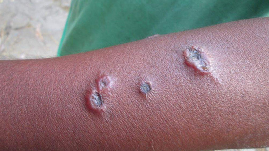 infected patient.jpg