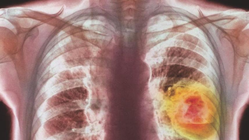 lung cancer.jpg