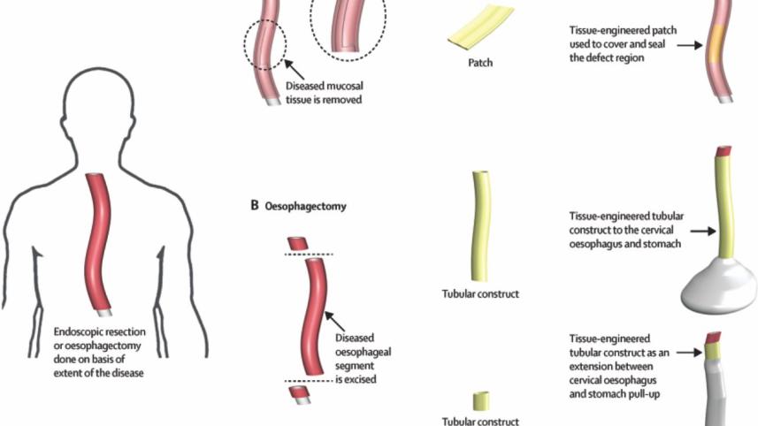 Reconstructing oesophagus.jpg