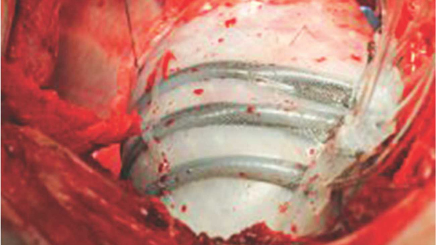 Robot Helps the Heart Beat