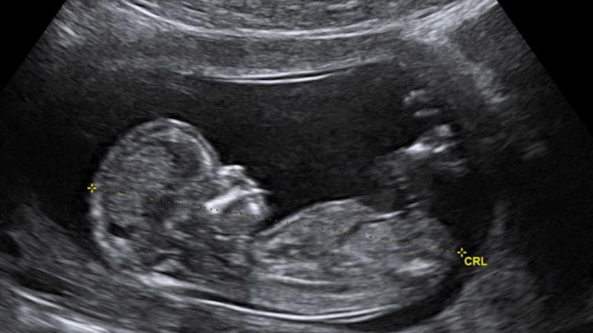 ULTRASOND CRL_Crown_rump_lengh_12_weeks_ecografia_Dr-1._Wolfgang_Moroder-1024x633.jpg
