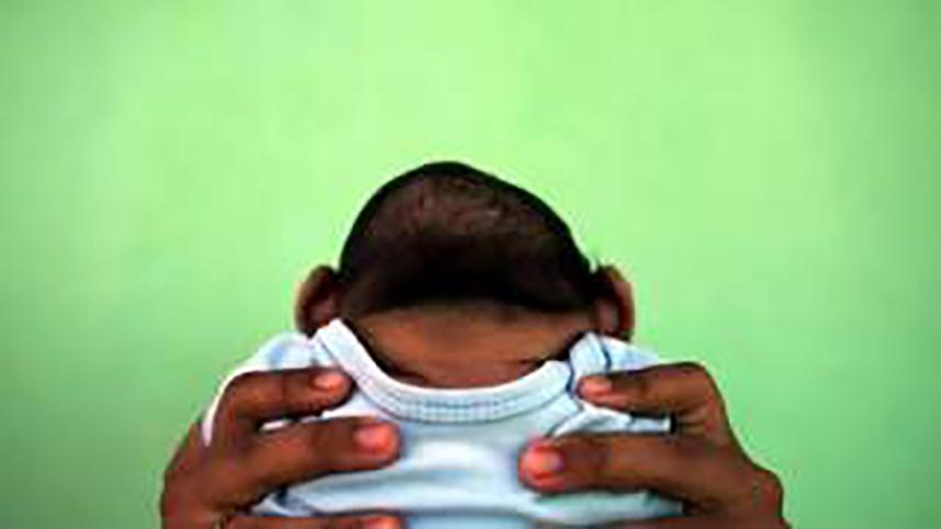 Zika microcephaly birth 