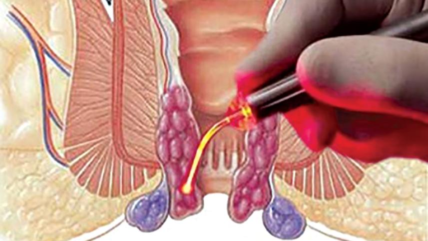 hemorrhoidal-disease.jpg