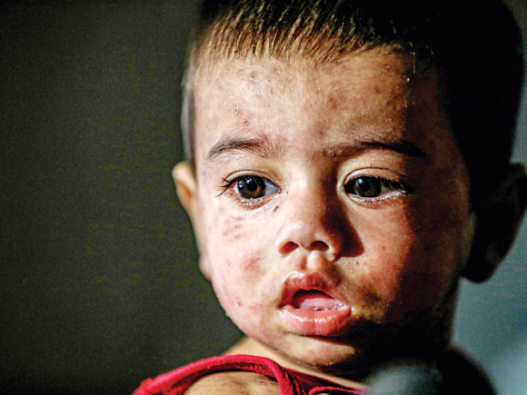 measles cases rising in Bangladesh