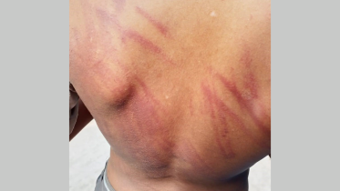 The victim, Md Abdullah, 12, suffered visible injuries in the incident, which sparked widespread outrage after photos of his wounds circulated on social media. Photo: Collected