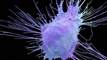 Prostate-cancer-cell-sem-web.jpg