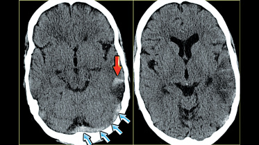 cerebral-venous-thrombosis-after-COVID-19.jpg