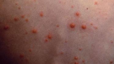 Chickenpox disease