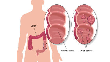 colon cancer.jpg