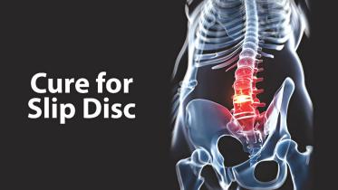 Vertebral disc prolapse