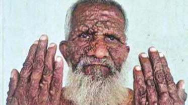 incurable disease Nilphamari.jpg