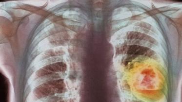 lung-cancer.jpg
