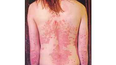 psoriasis.jpg