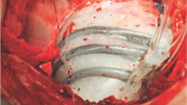 Robot Helps the Heart Beat