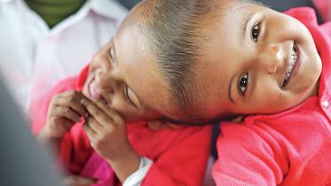 bangladeshi twins surgery