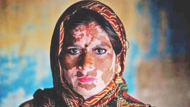 how to get rid of vitiligo permanently