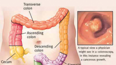 for-colon-cancer.jpg