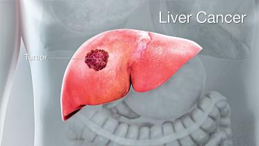 liver-cancer.jpg