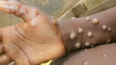 monkeypox-outbreak.jpg