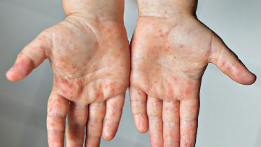 viral-hand-foot-mouth-disease.jpg