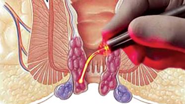 hemorrhoidal-disease.jpg