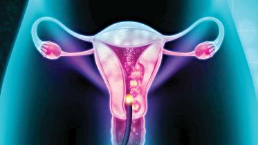 cervical-cancer.jpg