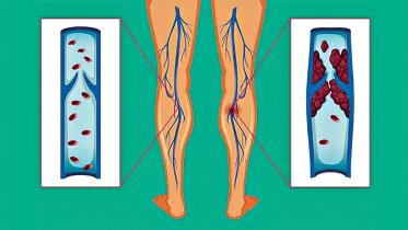 deep-vein-thrombosis.jpg