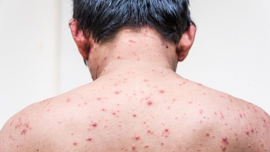 chickenpox-web.png
