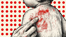 Measles.jpg