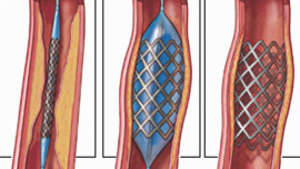 stenting.jpg