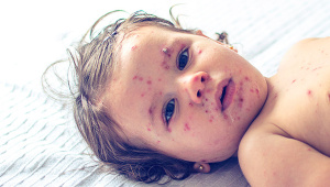 Combating-measles.jpg