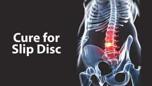 Vertebral disc prolapse