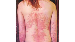 psoriasis.jpg