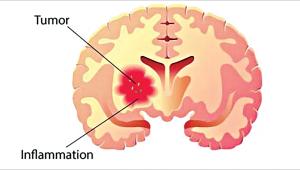 brain-tumours-treatment.jpg