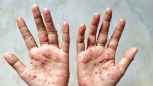 Monkeypox Virus