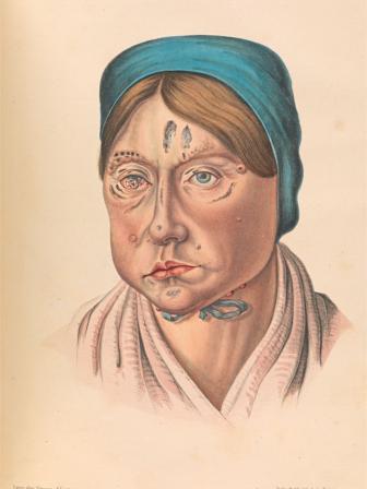 A 26-year-old woman with leprous lesions.