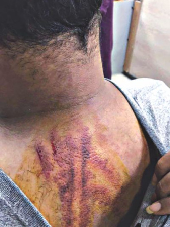 Injury marks on Shaer Reaz's back