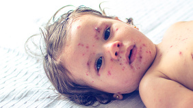 Combating-measles.jpg